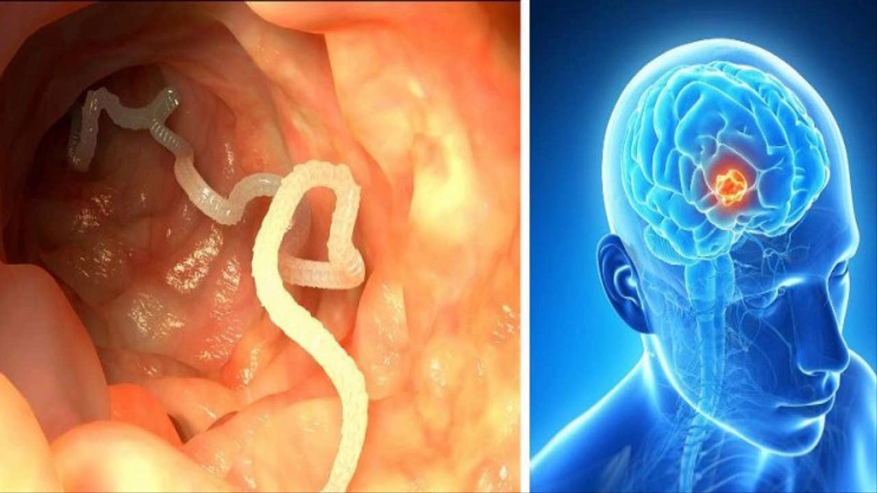 Descubren gusano en cerebro de hombre que ama la comida poco cocida. Noticias en tiempo real