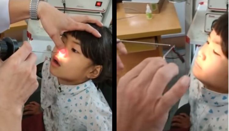 una sanguijuela viva se aloja en la nariz de una pequeña de 6 años video