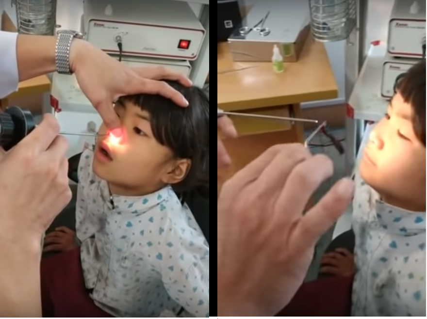 una sanguijuela viva se aloja en la nariz de una pequeña de 6 años video