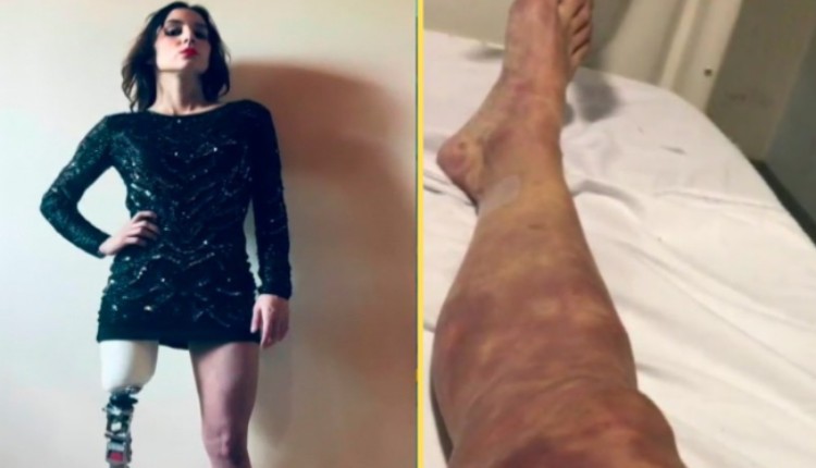 Modelo termina con pierna amputada tras atenderse una gripa en México. Noticias en tiempo real